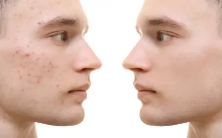 Sızanaqlar niyə yaranır, onlardan qurtulmağın yolları