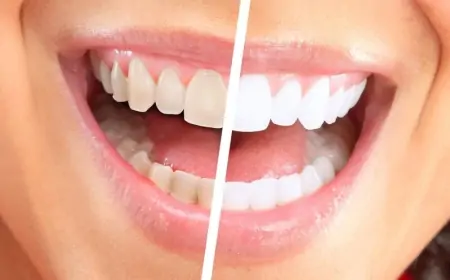 Dişləri ev şəraitində ağartmağın 6 üsulu