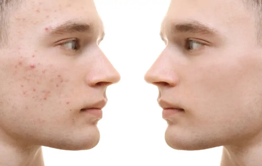 Sızanaqlar niyə yaranır, onlardan qurtulmağın yolları - Həkim rəyi