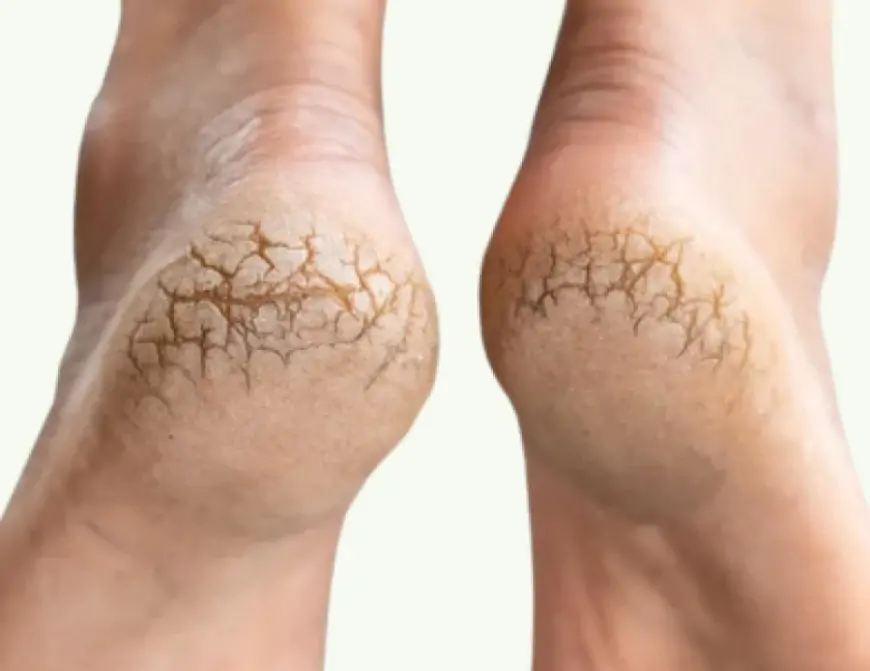 Daban çatlarından xilas olmağın – Təbii üsulları