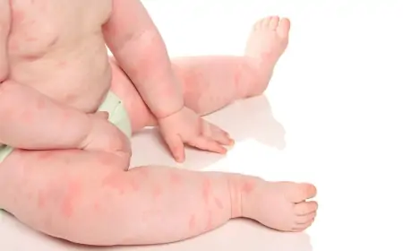 Uşaqlarda allergiyanın səbəbi nədir?