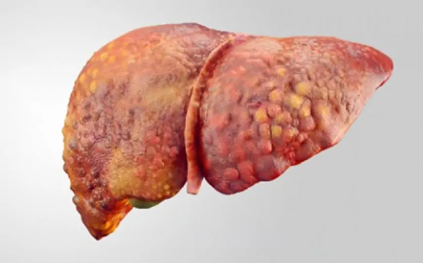 Qaraciyərdə piylənmə, səbəblər və müalicəsi 