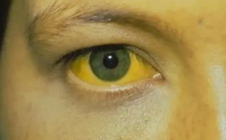 Sarılıq xəstəliyi keçicidir?