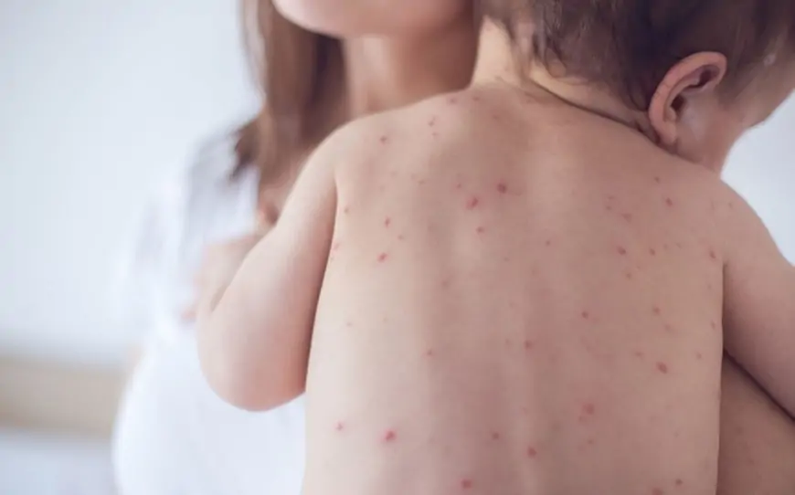 Suçiçəyi xəstəliyinin əlamətləri və müalicəsi 