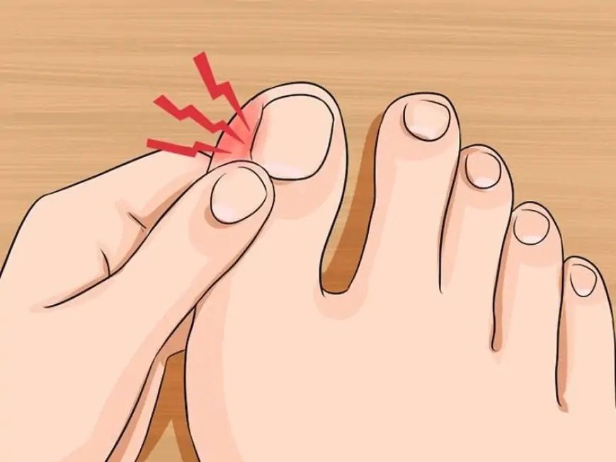 Dırnaq ətə batırsa, nə etməli? - Təsirli və sadə üsullar 