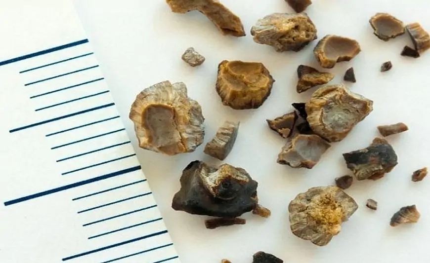 Böyrəklərdə daş niyə yaranır? - Səbəblər və çarələr