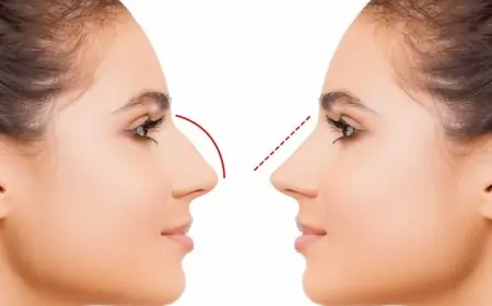 Azərbaycanda bu şəxslərə burun əməliyyatı pulsuz OLDU 