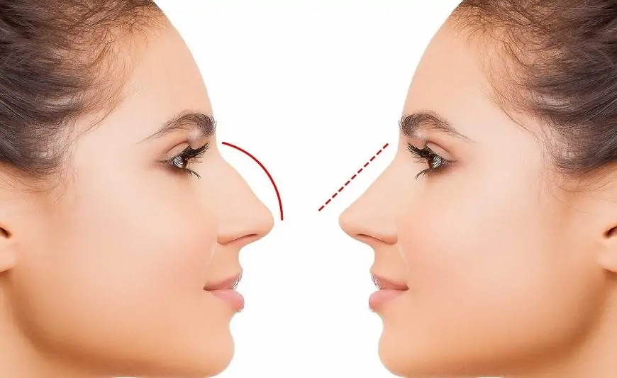 Azərbaycanda bu şəxslərə burun əməliyyatı pulsuz OLDU 